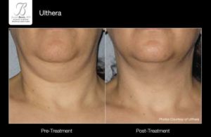 Ulthera Before and After Results