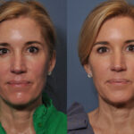 Dermal FiIller Before and After