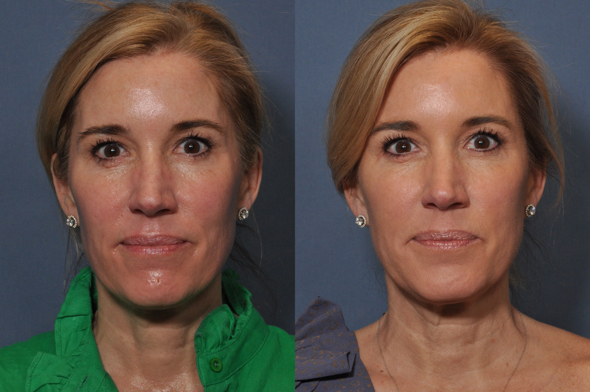 Dermal FiIller Before and After