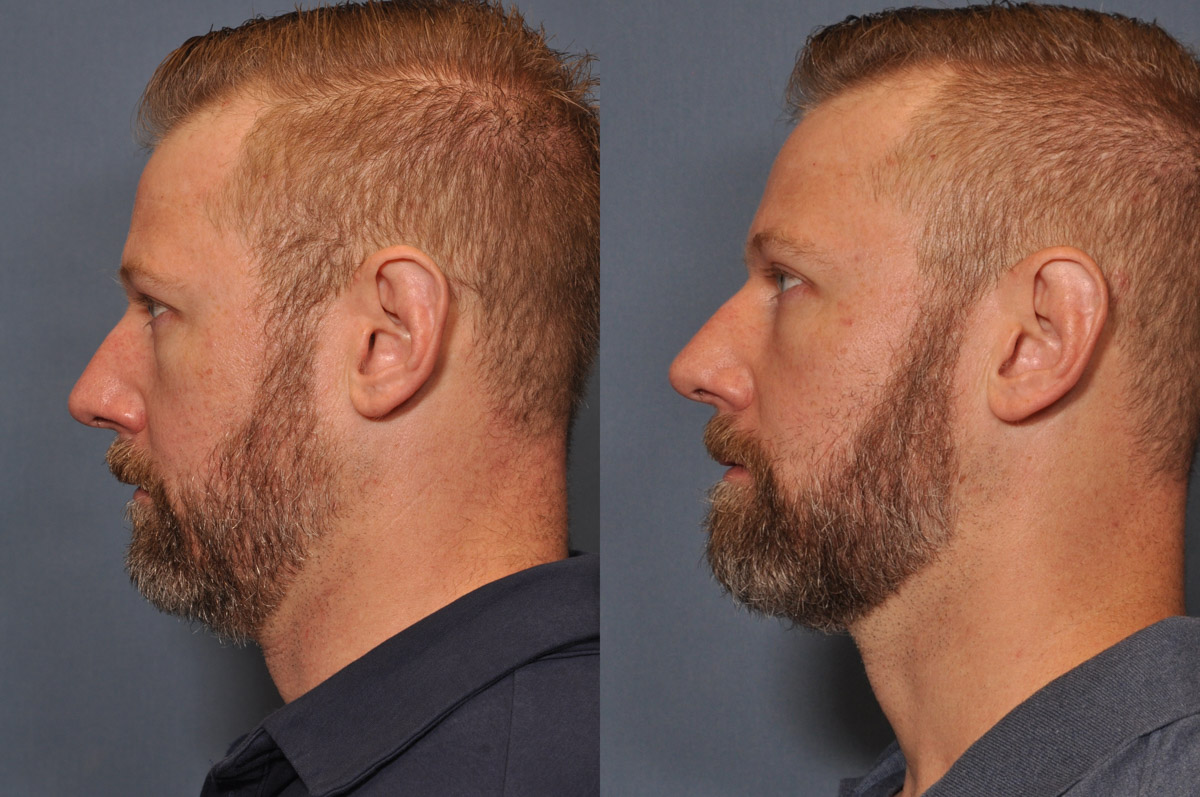 Dermal FiIller Before and After