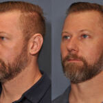 Dermal FiIller Before and After