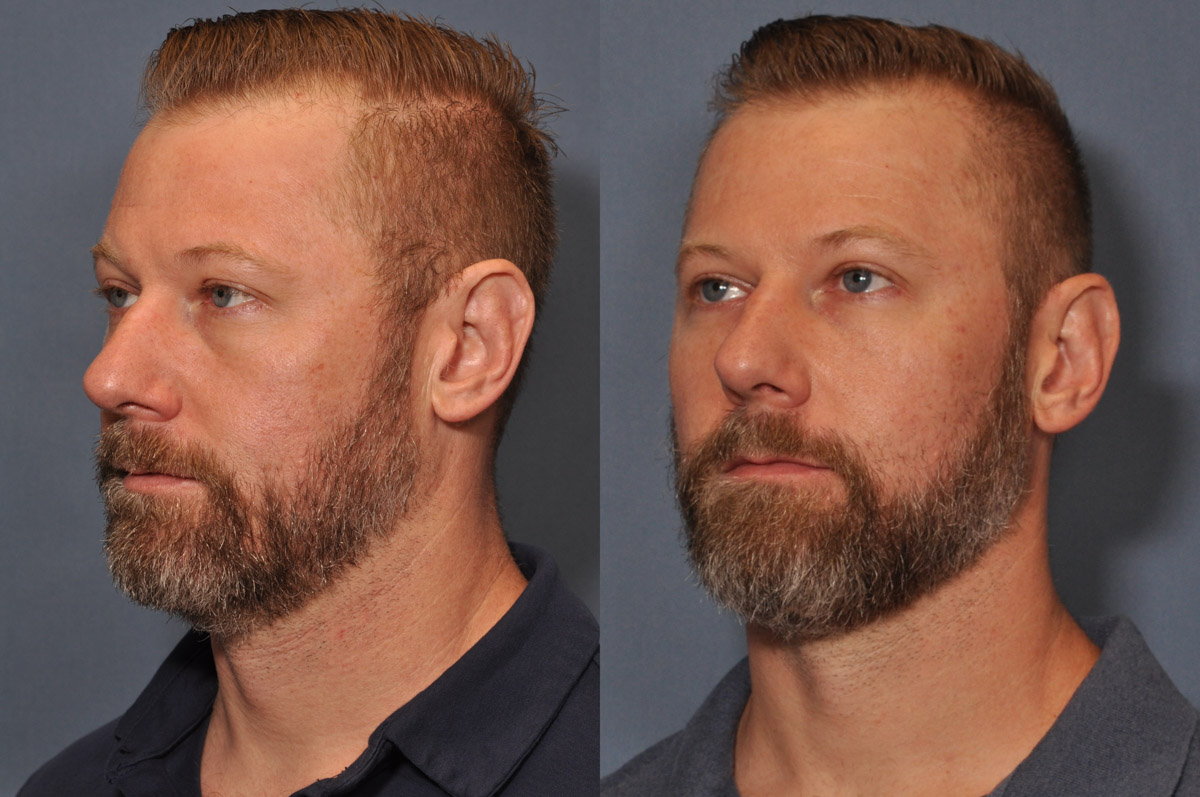 Dermal FiIller Before and After
