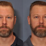 Dermal FiIller Before and After