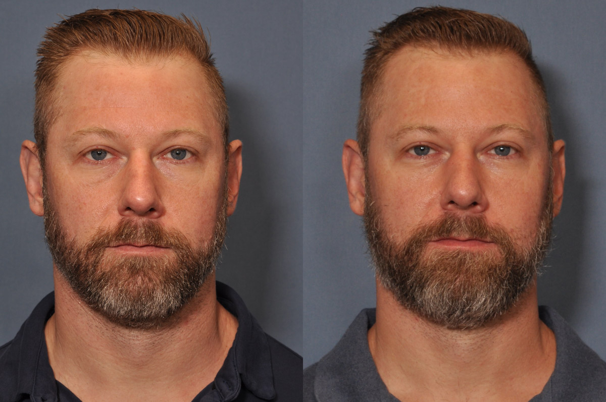 Dermal FiIller Before and After