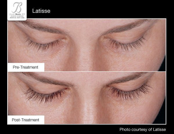 Latisse-before-after