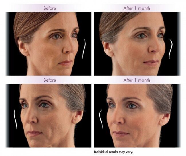 Voluma-e1449079657976 ulthera before and after