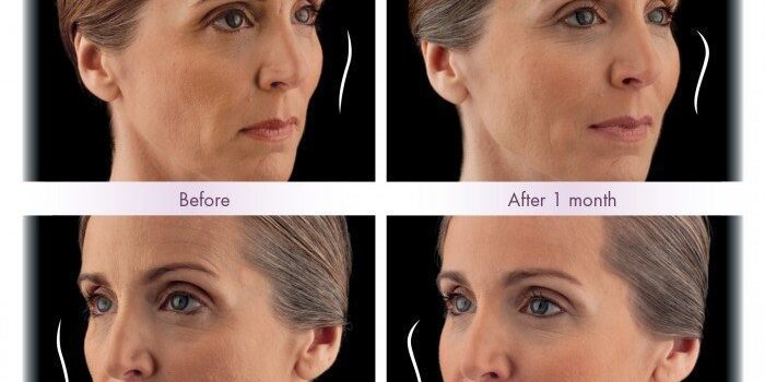 ulthera before and after