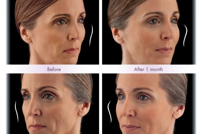 ulthera before and after