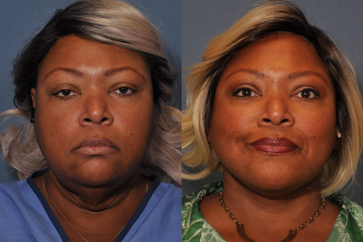 Neck Lift before and after
