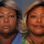 Neck Lift before and after