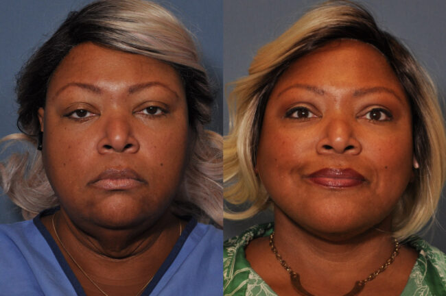 Neck Lift before and after