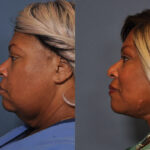 Neck lift before and after