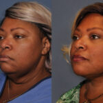Neck lift before and after
