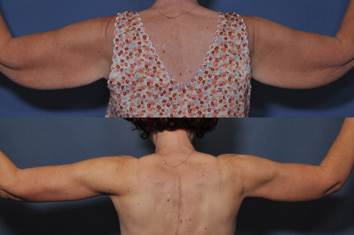 Arm lift with liposuction before and after