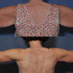 Arm lift with liposuction before and after