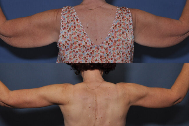 Arm lift with liposuction before and after