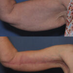 Arm Lift before and after