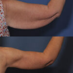 Arm Lift before and after