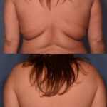 Bra Line Lift before and after