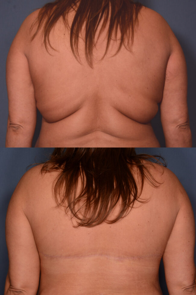 Bra Line Lift before and after