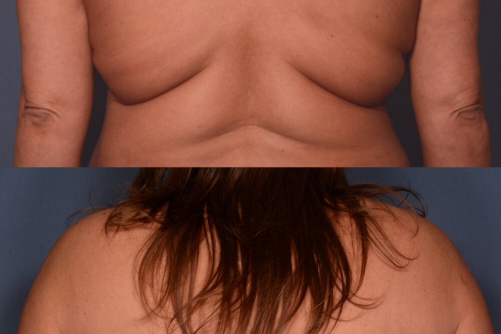 Bra Line Lift before and after