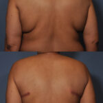 Mini Bra Line Lift before and after