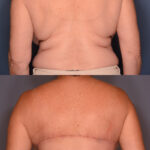 Bra Line Lift before and after