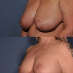 Breast Reduction Before and After
