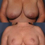 Breast Reduction Before and After