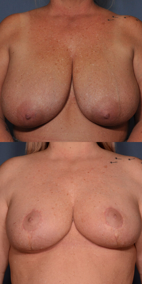 Breast Reduction Before and After