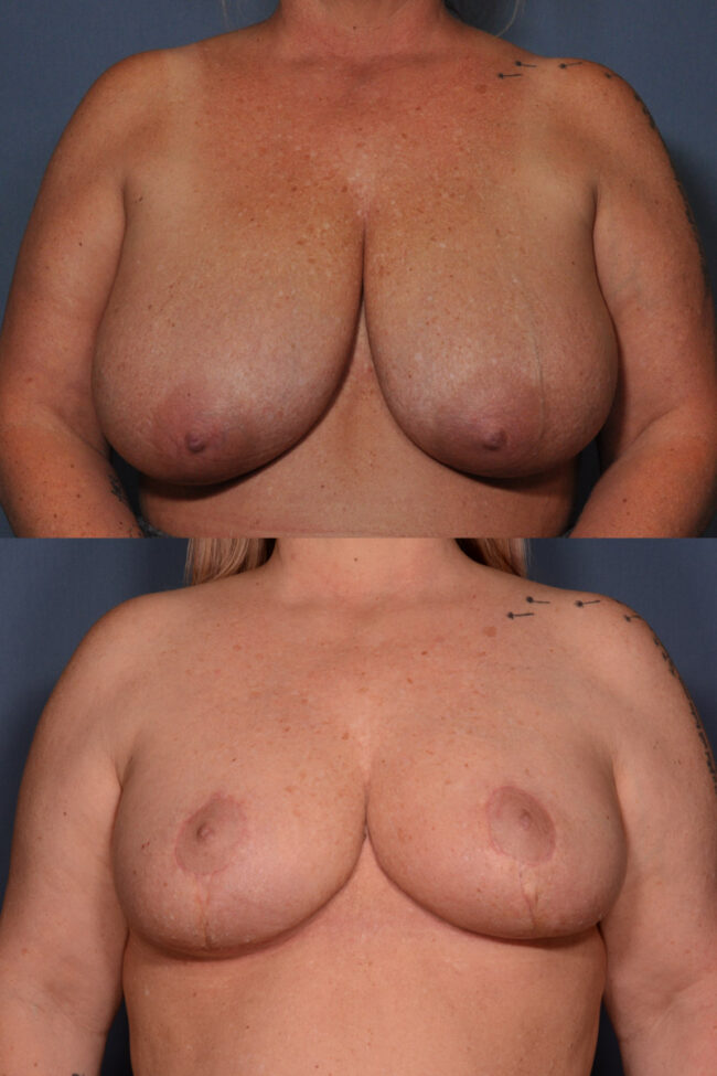 Breast Reduction Before and After