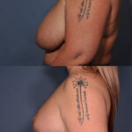 Breast Reduction Before and After