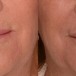 C02 treatment before and after