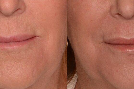 C02 treatment before and after
