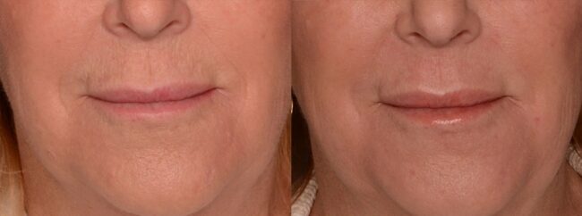 C02 treatment before and after