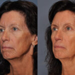 Eyelid Surgery before and after