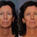 Eyelid Surgery before and after