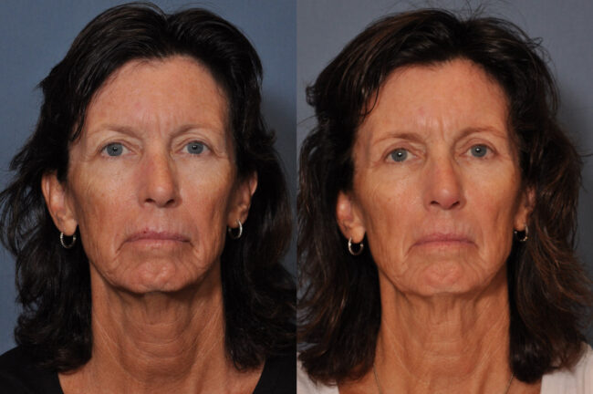 Eyelid Surgery before and after