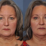 Eyelid Surgery before and after