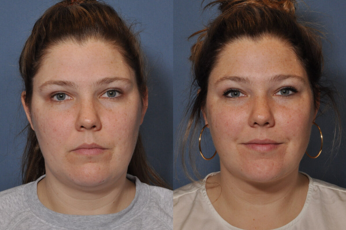 Fat Grafting before and after