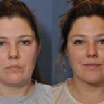 Fat Grafting before and after