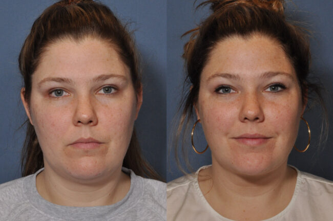 Fat Grafting before and after
