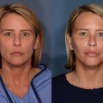 Face lift and Neck lift before and after photo
