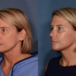 Facial Fat Grafting - 6 weeks Post op- Lower Face Lift and Neck Lift with Fat Grafting to Cheeks, Lips, Marionette Sulcus