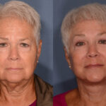 Lip Lift before and after