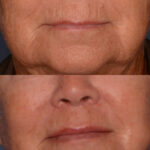 Lip Lift before and after