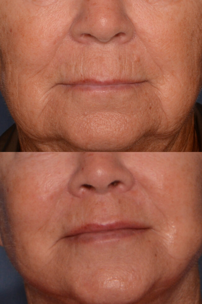 Lip Lift before and after
