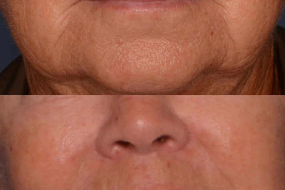 Lip Lift before and after