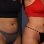 Liposuction - SAL of Back, Waistline and Abdomen (2)