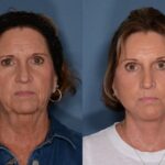 Facelift before and after